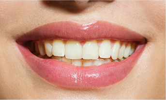 Before enlighten teeth whitening - The Smile Boutique 