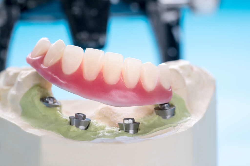 Implant Retained Dentures Peterborough